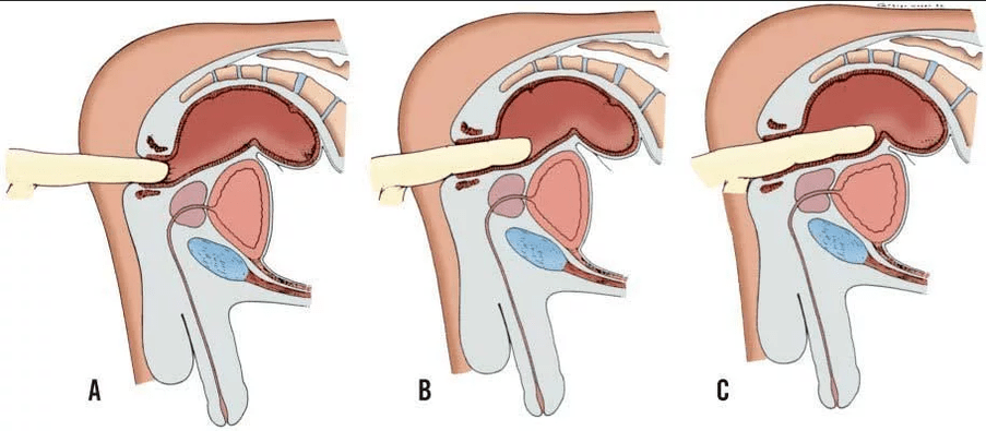 Examen rectal des doigts